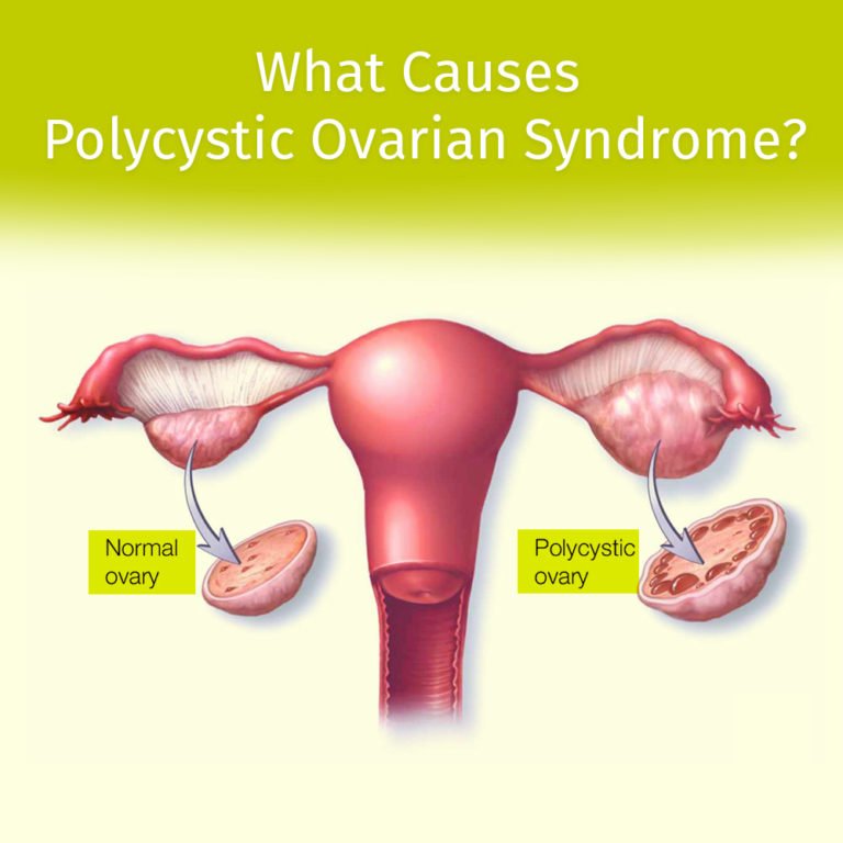 What Causes PCOS Dr Seema Sharma